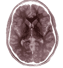 Exame de ressonância magnética de um cérebro humano. Imagem: Wikimedia Commons.