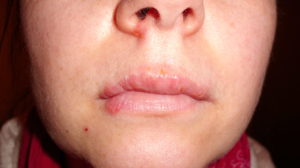 herpes