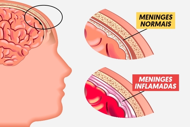 meningite